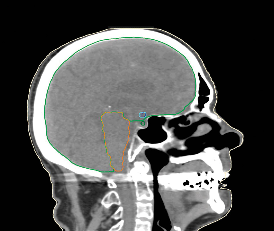 Brain CT Model