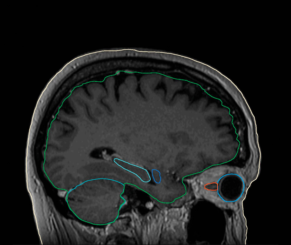 Brain MR Model