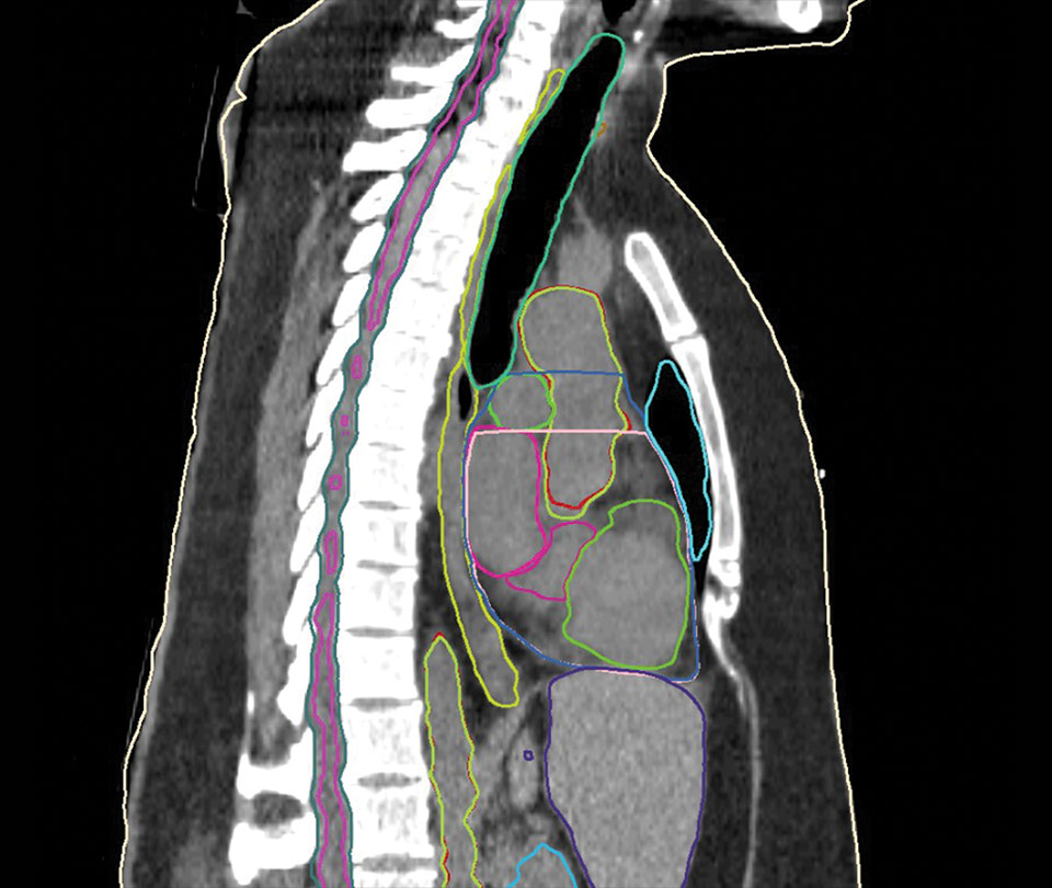Breast CT Model
