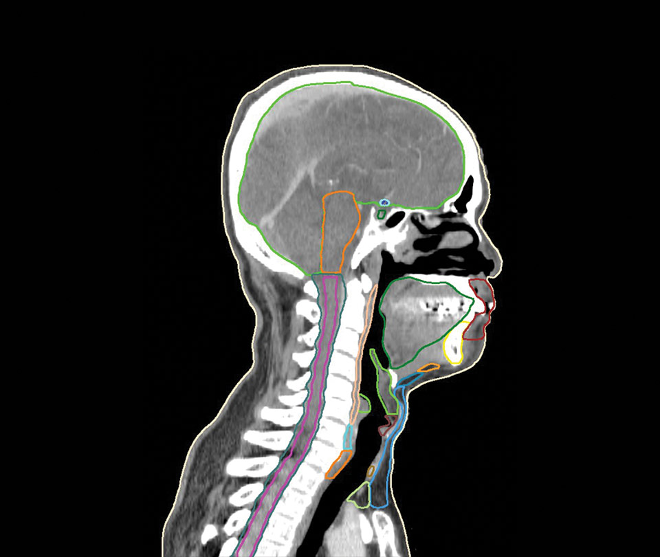Head & Neck CT Model