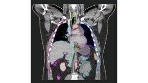 This image displays a preview of our Lung CT model, following the SABR consortium guideline.