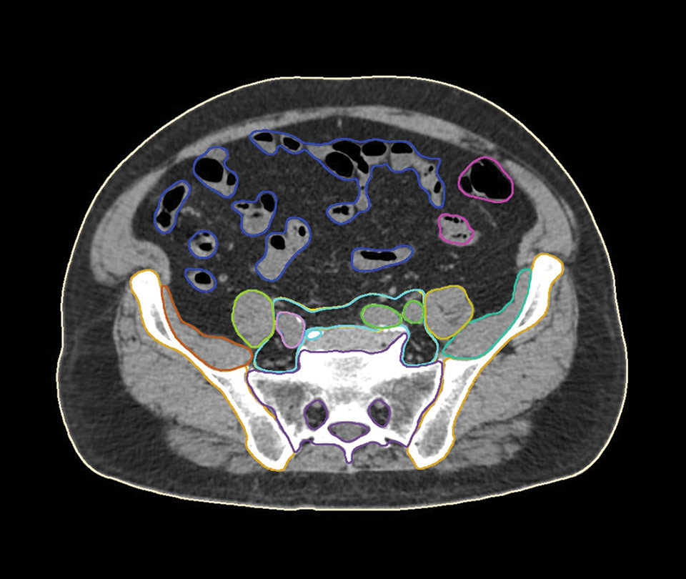 Male Pelvis CT Model