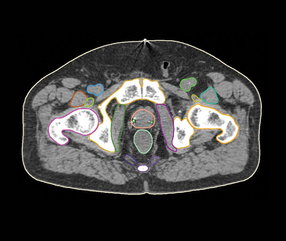 Male Pelvis CT Model